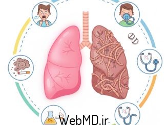 بیماری ریه بینابینی