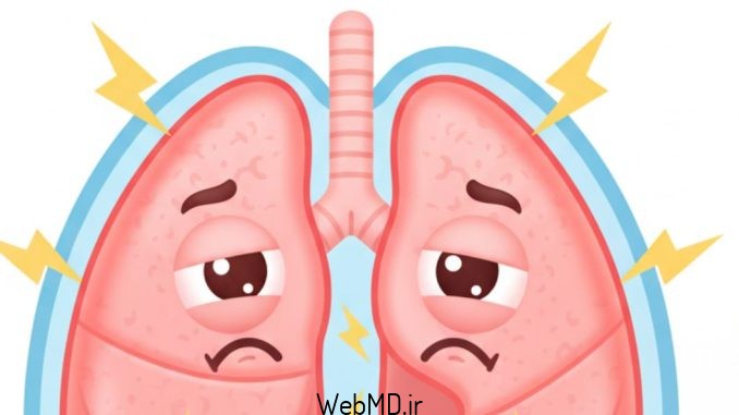 ذات الجنب (پلوریت)