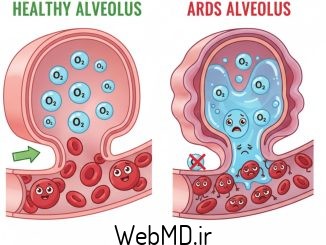 سندرم دیسترس تنفسی حاد (ARDS)