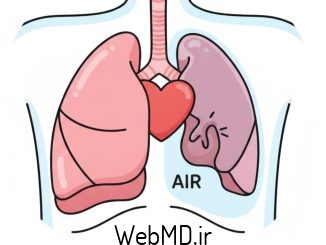 پنوموتوراکس (فروپاشی ریه)