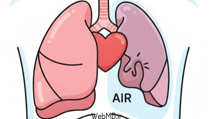 پنوموتوراکس (فروپاشی ریه)