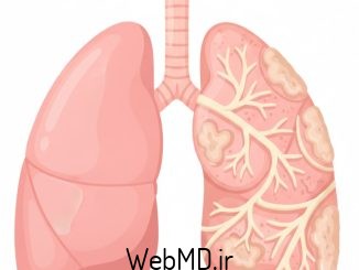 فیبروز ریوی ایدیوپاتیک