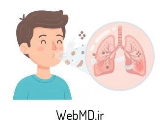 پنومونیت ناشی از حساسیت