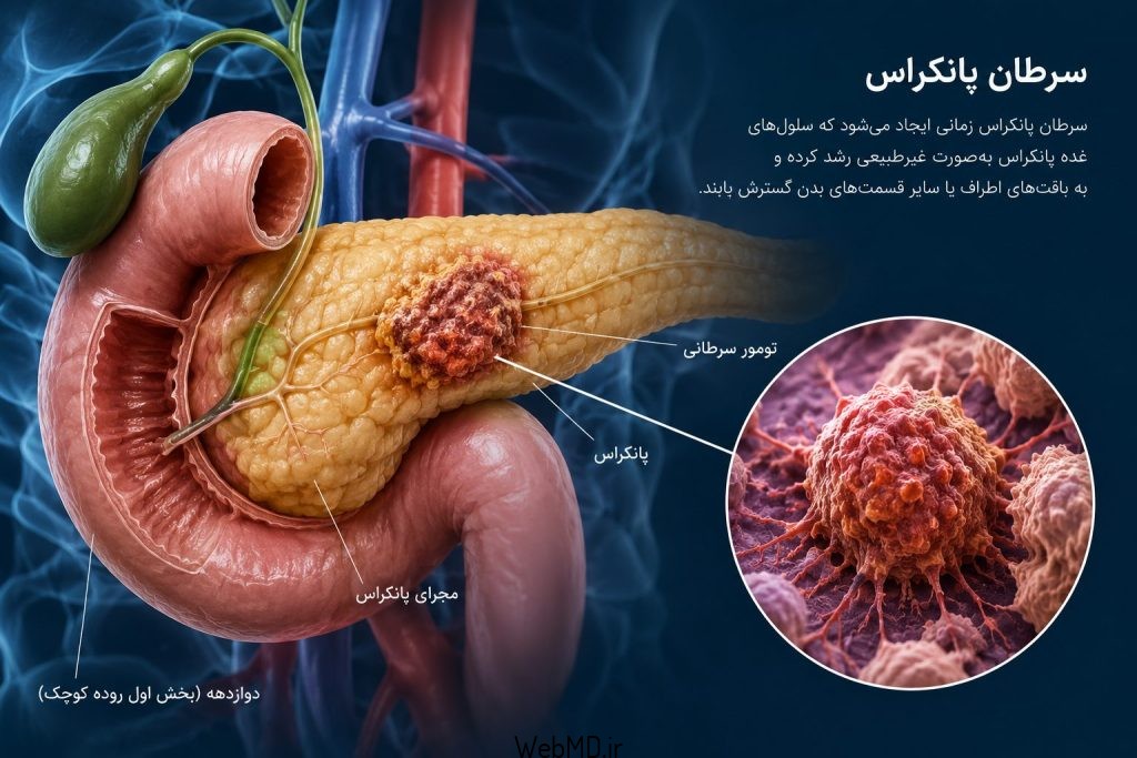 سرطان پانکراس معمولاً از دشوارترین سرطان‌ها برای درمان است. 