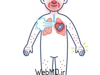 سندرم چرگ-اشتراوس