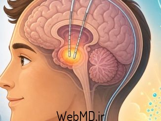 تحریک عمقی مغز (DBS)