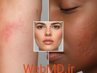 کهیر، اورتیکاریا و آنژیوادم