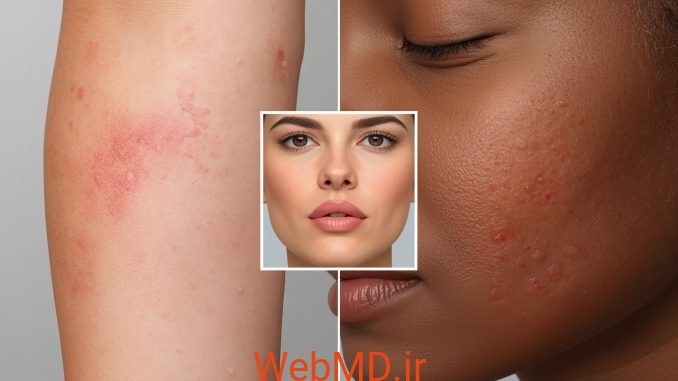 1 (2) کهیر، اورتیکاریا و آنژیوادم