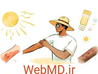 آفتابسوختگی