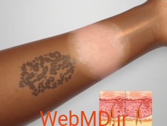 افزایش و کاهش رنگدانه‌های پوست