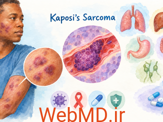 سارکوم کاپوزی (Kaposi’s Sarcoma؛ KS)