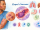 سارکوم کاپوزی (Kaposi’s Sarcoma؛ KS)