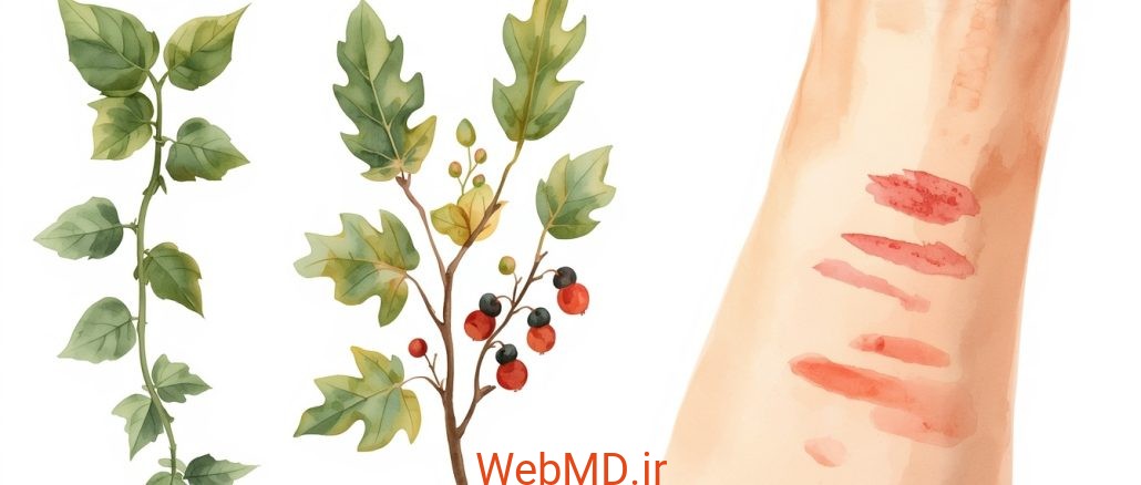 حساسیت به پیچک سمی