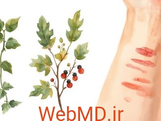 حساسیت به پیچک سمی