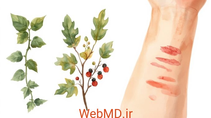 حساسیت به پیچک سمی